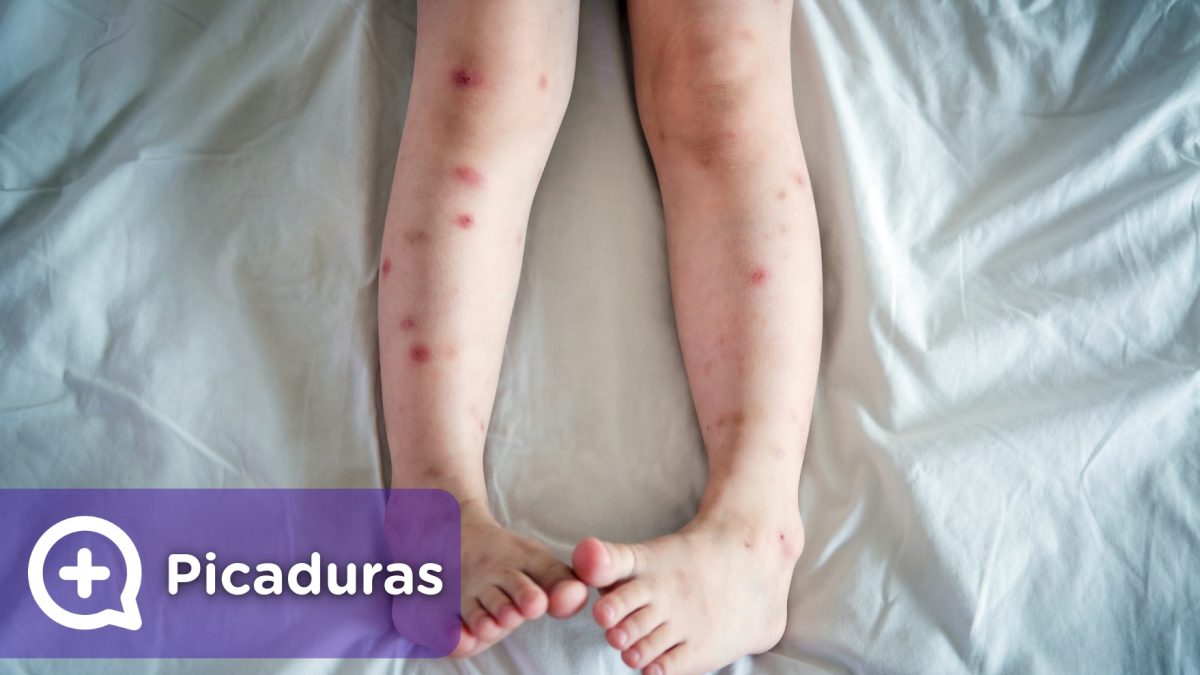 Picaduras y ronchas en piernas, cara, brazos, cuerpo, producidas por mosquitos, arañas, insectos