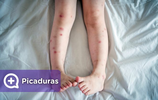 Picaduras y ronchas en piernas, cara, brazos, cuerpo, producidas por mosquitos, arañas, insectos