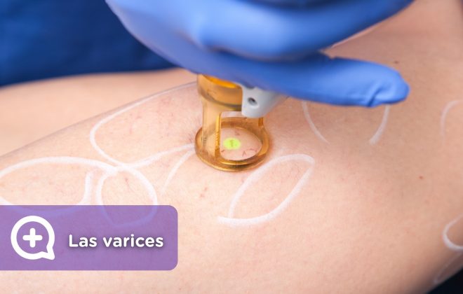 Tratamiento para varices, arañas vasculares, piernas cansadas, mujer.