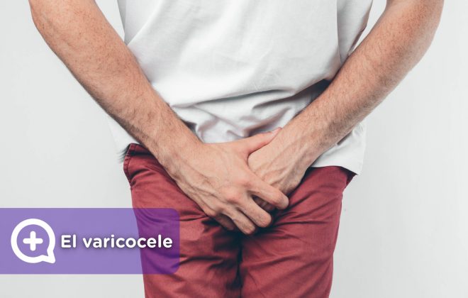 el varicocele Es un cordón espermático que hay alrededor de los testículos, compuesto de arterias, venas y nervios, que transporta sangre a los testículos, así como el semen hasta el conducto deferente.