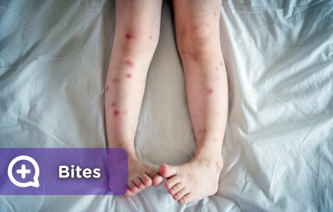 Bites and welts on legs, face, arms, body, produced by mosquitos, spiders, insects