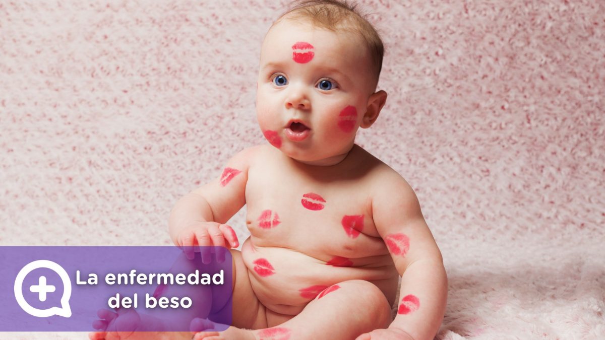 Mononucleosis o enfermedad del beso. Infección por el contacto con la saliva.