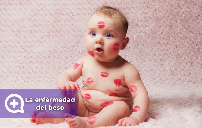 Mononucleosis o enfermedad del beso. Infección por el contacto con la saliva.