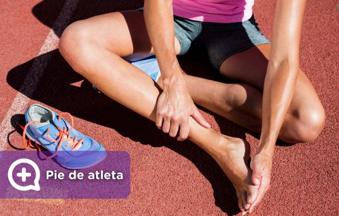 Mujer deportista con pie de atleta, afección en los pies, hongos