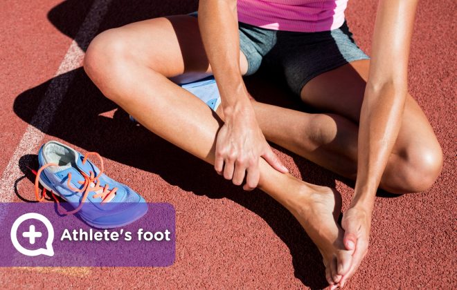 Woman athlete with athlete's foot, foot condition, fungus