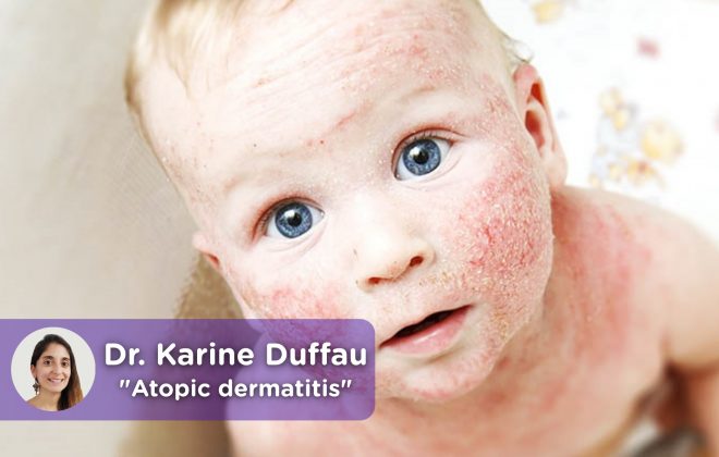 Child atopic dermatitis. MediQuo, your doctor friend. Medical chat Dr. Karine Duffau.