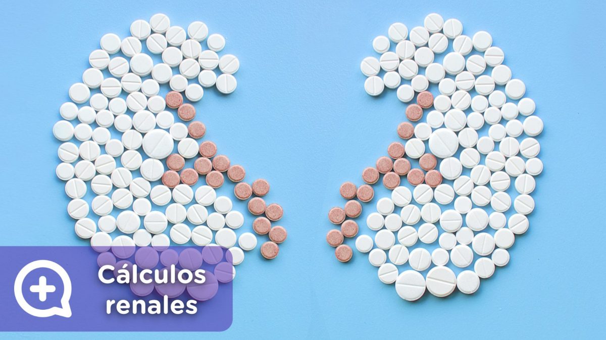 cálculos renales, litotricia, piedras en el riñón. mediQuo, tu amigo médico. Chat médico.