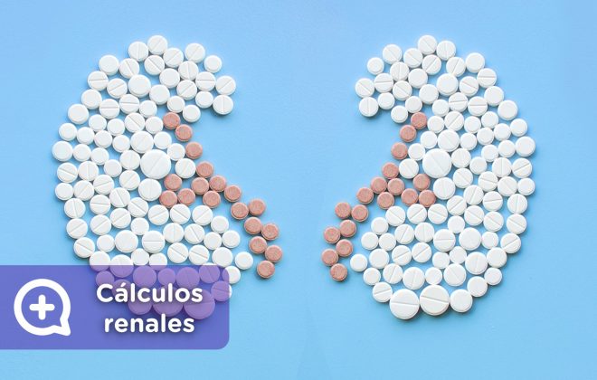 cálculos renales, litotricia, piedras en el riñón. mediQuo, tu amigo médico. Chat médico.