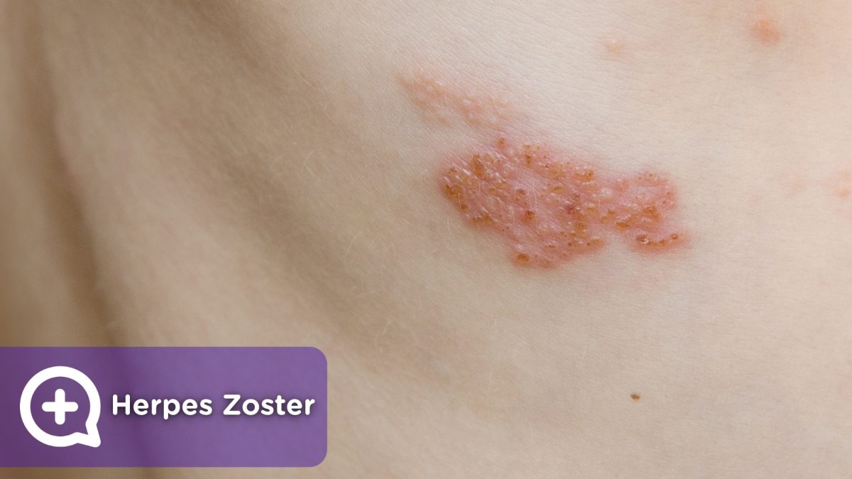 Herpes zoster virus, chickenpox, infection.