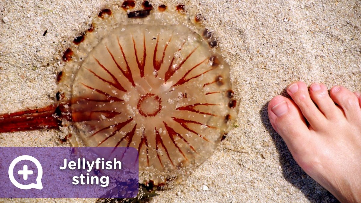 Jellyfish sting, bank of poisonous jellyfish on the beach, Portuguese carabela