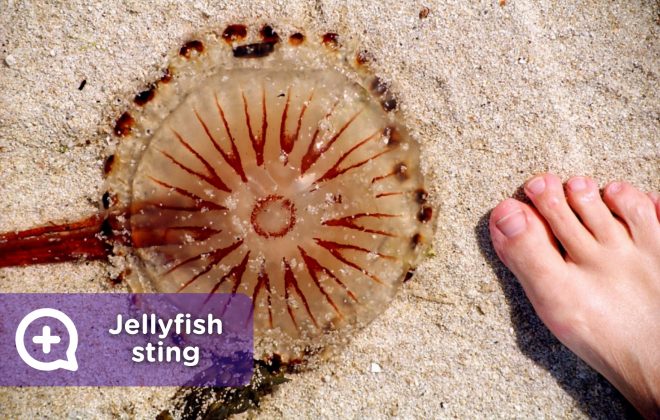 Jellyfish sting, bank of poisonous jellyfish on the beach, Portuguese carabela