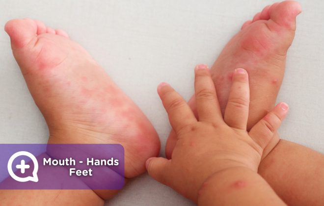 The hand mouth and foot disease is very contagious