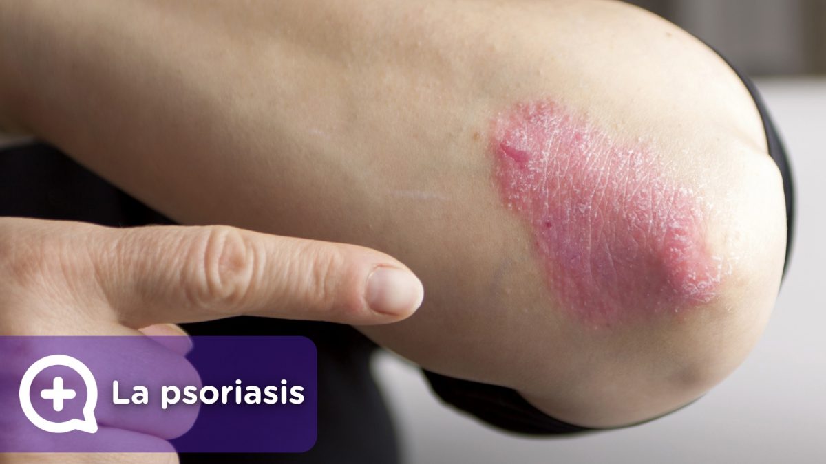 La psoriasis, tratamiento, como curarla. MediQuo, tu amigo médico. chat médico.