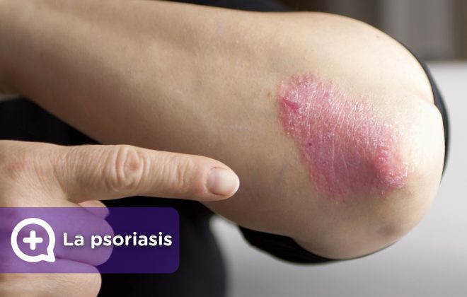 La psoriasis, tratamiento, como curarla. MediQuo, tu amigo médico. chat médico.