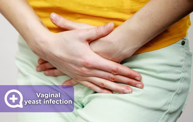 Woman affected by vaginal yeast infection