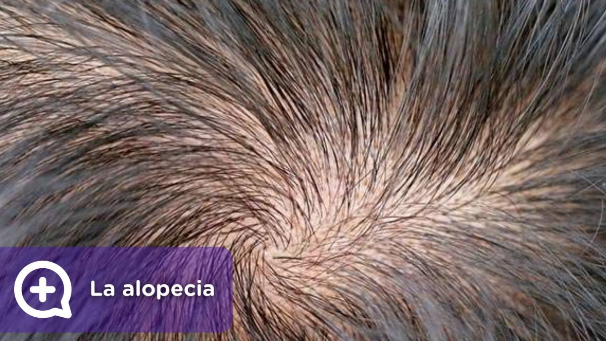 Alopecia, pérdida de cabello. Tratamiento. MediQuo, Tu amigo médico, chat médico.