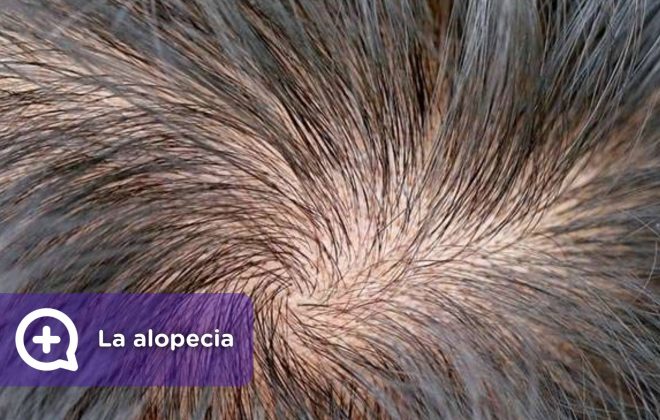 Alopecia, pérdida de cabello. Tratamiento. MediQuo, Tu amigo médico, chat médico.