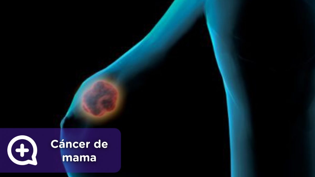 Cáncer de mama. MediQuo, Tu amigo médico. Chat médico.