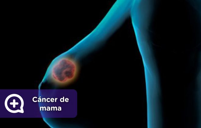 Cáncer de mama. MediQuo, Tu amigo médico. Chat médico.