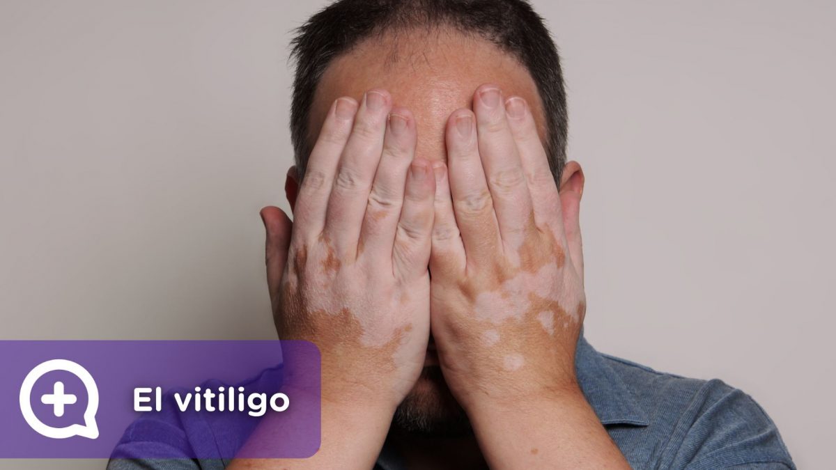 Vitiligo, problemas en la piel. Cambio de color. Pérdida de pigmentación. Mediquo. Dermatología. Chat médico. Tu amigo médico.