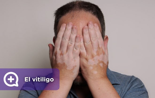 Vitiligo, problemas en la piel. Cambio de color. Pérdida de pigmentación. Mediquo. Dermatología. Chat médico. Tu amigo médico.