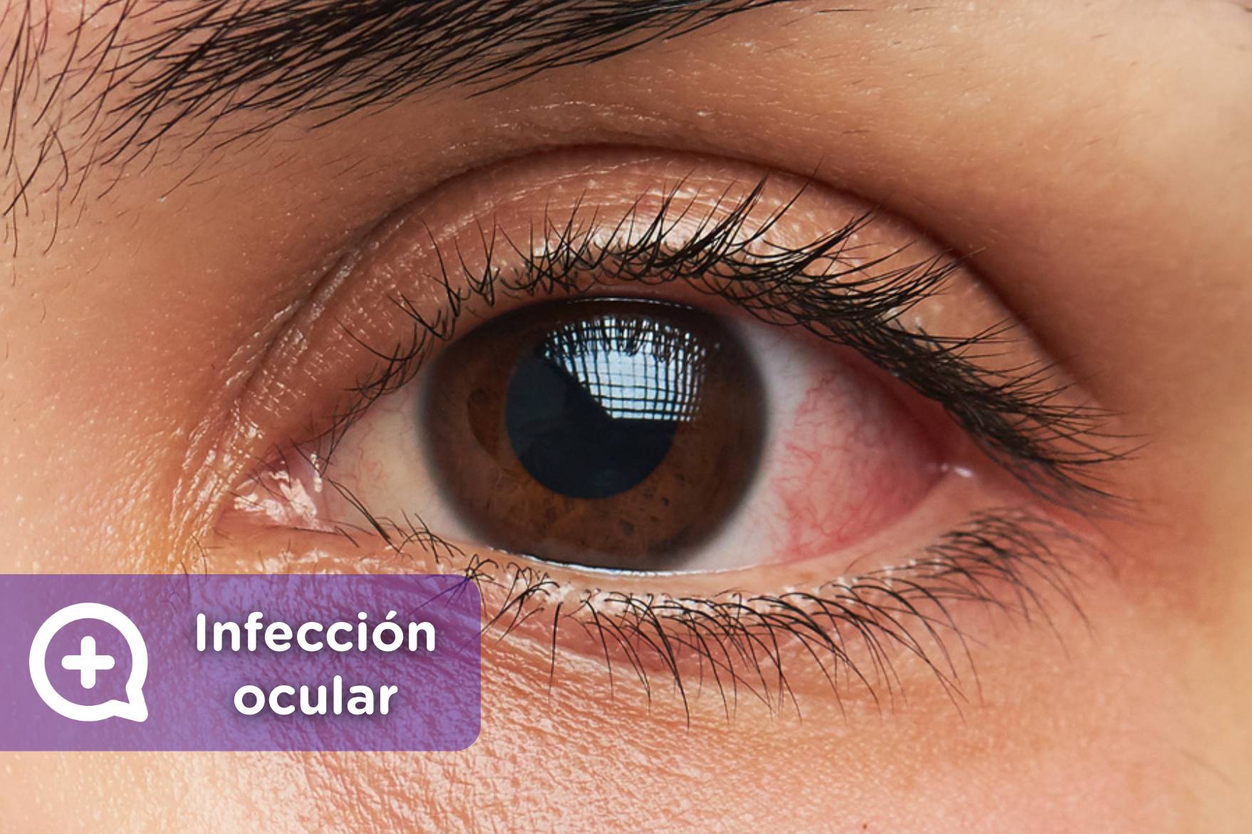 estación de televisión Contagioso azafata Tienes infección ocular? Esto es lo que debes hacer - mediQuo estación de televisión Contagioso azafata Tienes infección ocular? Esto es lo que debes hacer - mediQuo