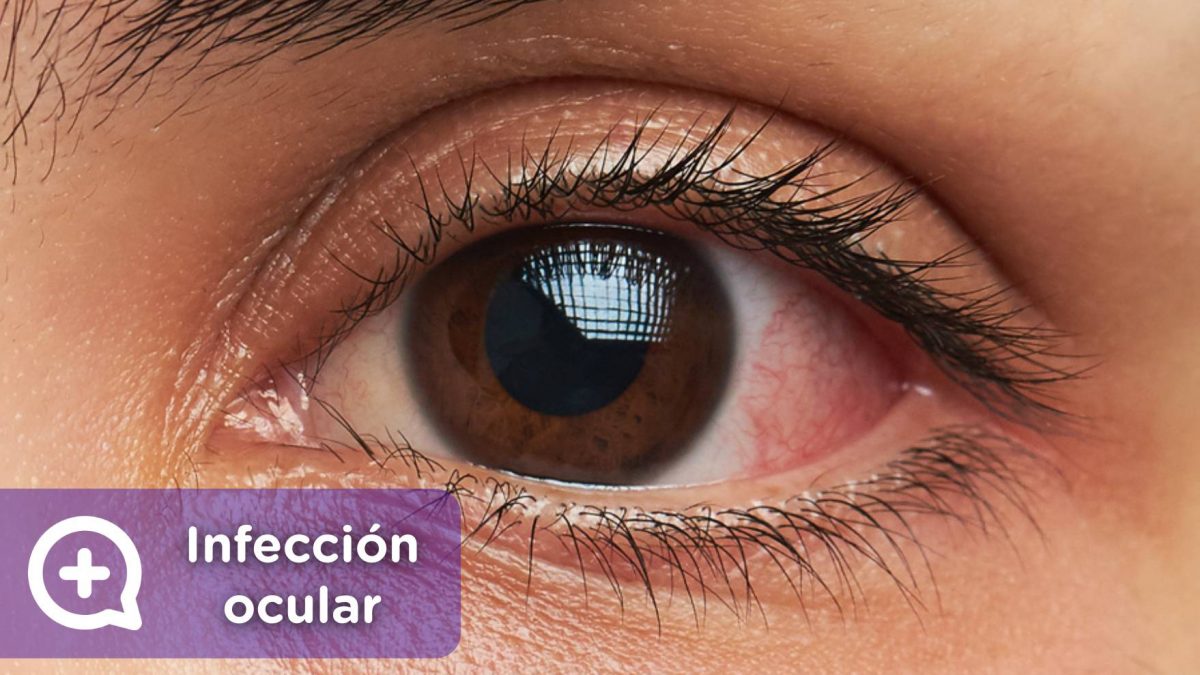 Infección ocular. Lentes de contacto, lentillas, ojos, problemas oculares, conjuntivitis. Mediquo. Tu amigo médico. Chat médico.