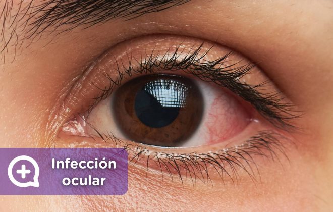 Infección ocular. Lentes de contacto, lentillas, ojos, problemas oculares, conjuntivitis. Mediquo. Tu amigo médico. Chat médico.