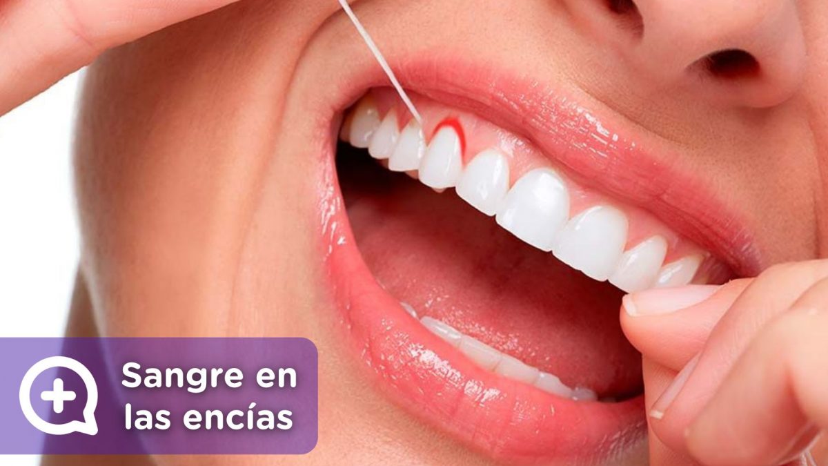 Sangrado de encías, sarro, suciedad. Salud bucal. Enjuague bucal. Dientes. Dentista. Mediquo. Tu amigo médico. Chat médico.