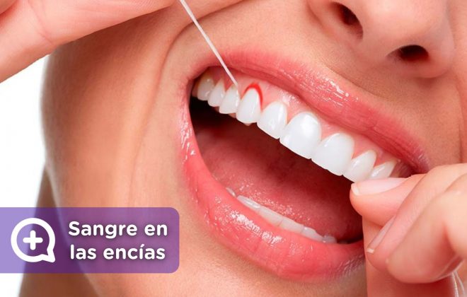 Sangrado de encías, sarro, suciedad. Salud bucal. Enjuague bucal. Dientes. Dentista. Mediquo. Tu amigo médico. Chat médico.