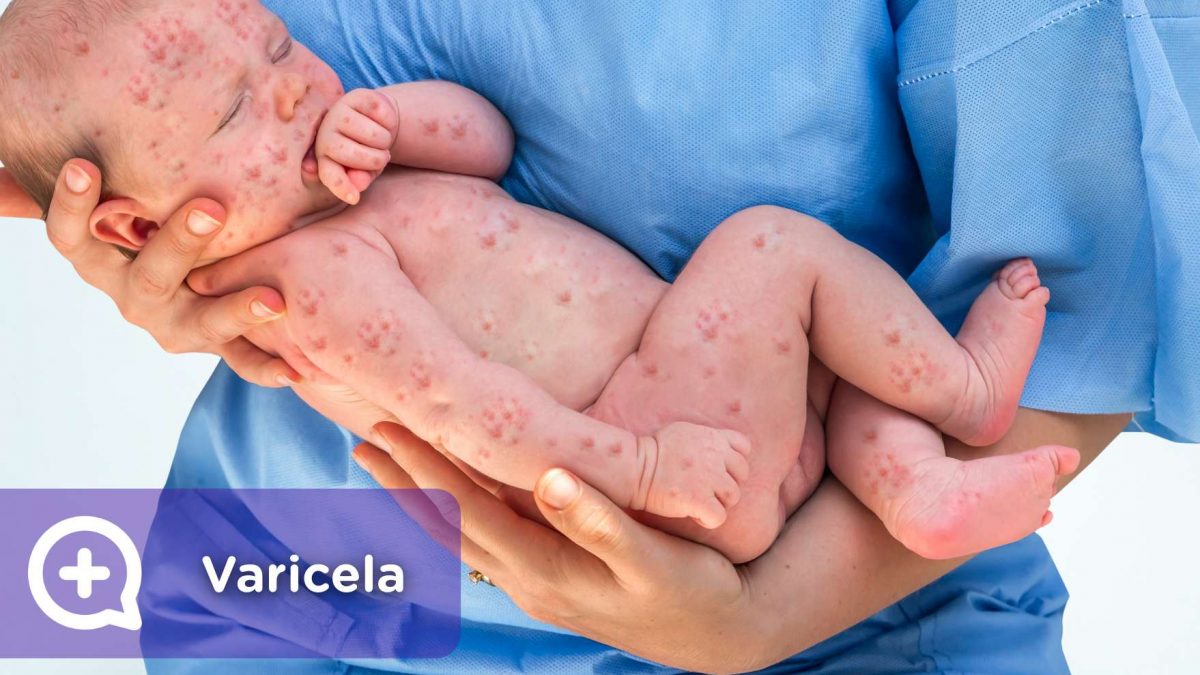 Niño con el virus de la varicela. Herpes Zoster. MediQuo, Tu amigo médico. Chat médico.