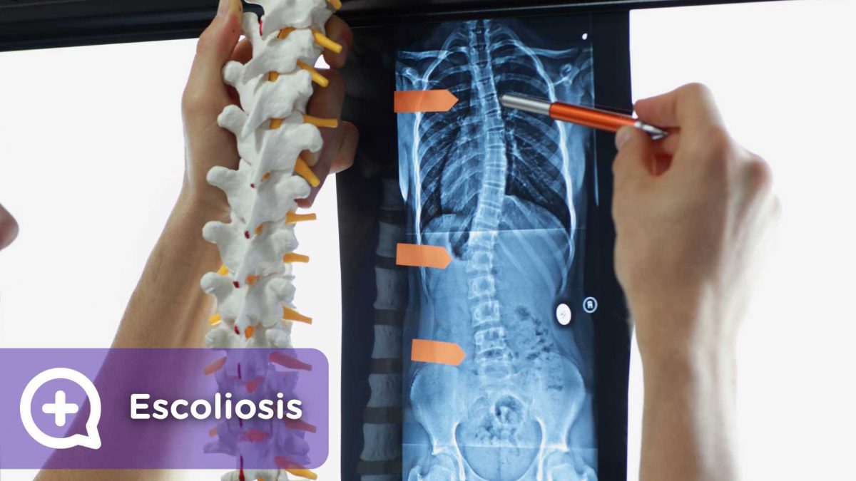 Escoliosis, dolor de espalda, S. Dolor cervical. columna vertebral. Mediquo, tu amigo médico. Chat médico.