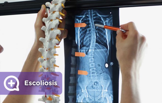 Escoliosis, dolor de espalda, S. Dolor cervical. columna vertebral. Mediquo, tu amigo médico. Chat médico.