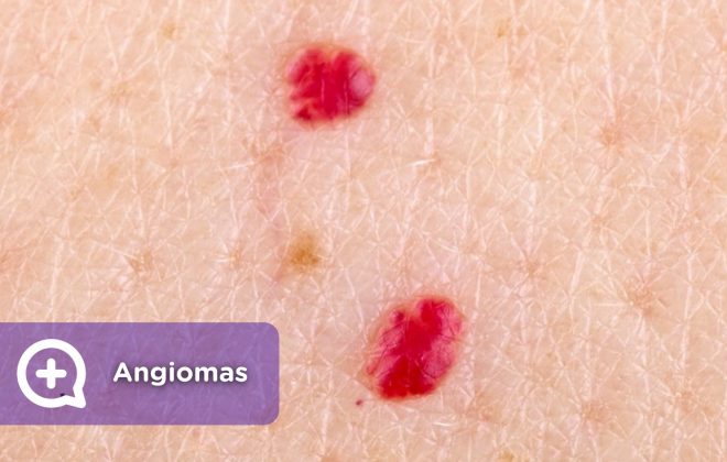 angioma, mancha rojiza, piel, dermatología. Mediquo, Salud, Tu amigo médico. Chat médico.