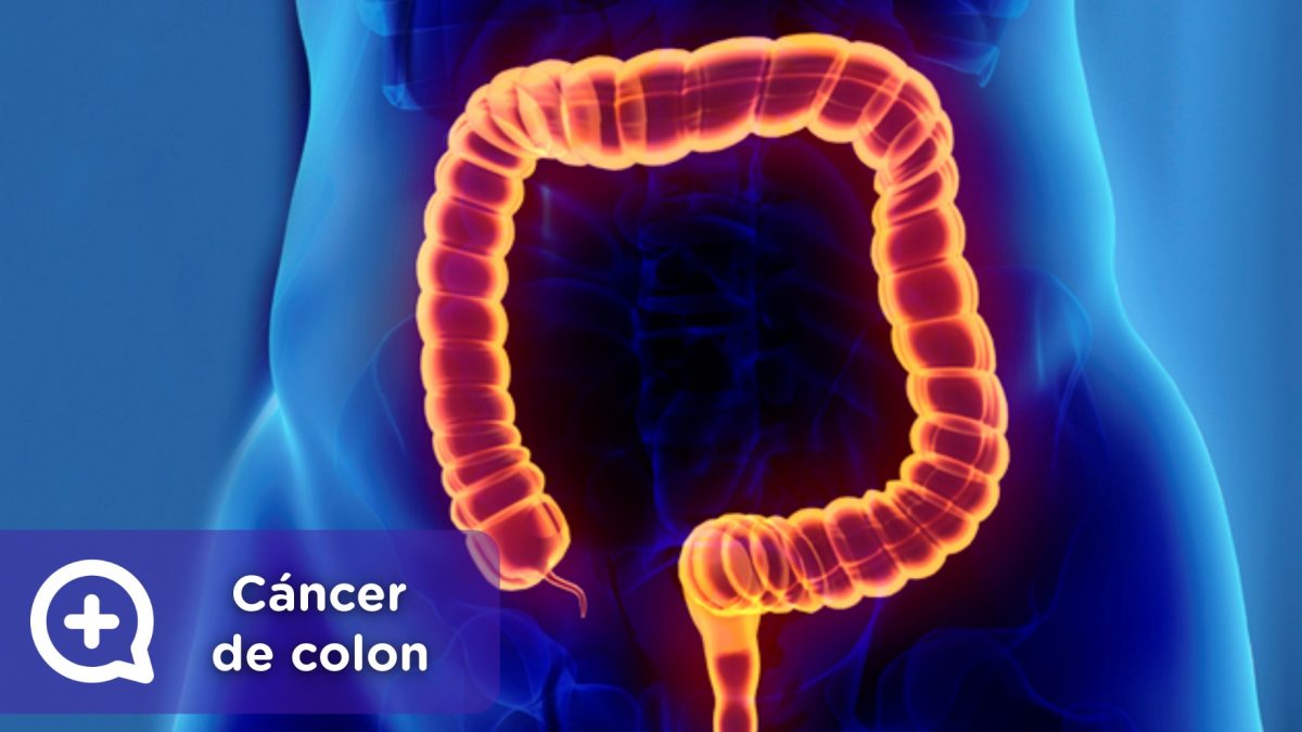 Cáncer de colon, síntomas de alarma. Tumor maligno. Mediquo, Tu amigo médico. Chat médico. Cáncer de colon, síntomas de alarma. Tumor maligno. Mediquo, Tu amigo médico. Chat médico.