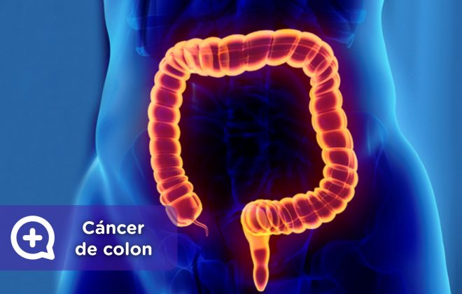 Cáncer de colon, síntomas de alarma. Tumor maligno. Mediquo, Tu amigo médico. Chat médico. Cáncer de colon, síntomas de alarma. Tumor maligno. Mediquo, Tu amigo médico. Chat médico.