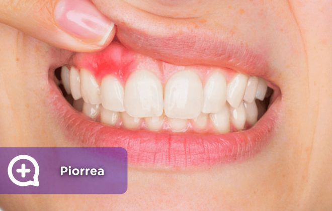 Piorrea, salud dental, prevención. mediquo, tu amigo médico. Chat médico.