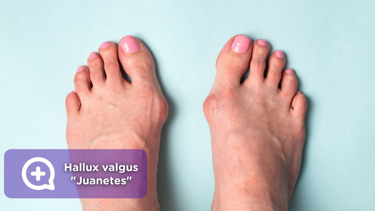 Hallux valgus, juanetes, deformidad, pies, dolor. Mediquo, tu amigo médico. Chat médico.