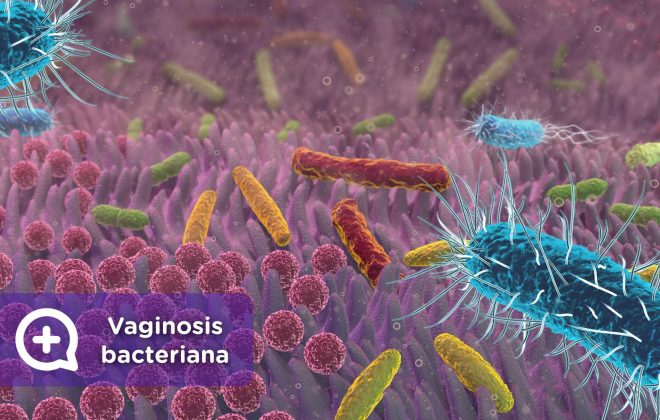 vaginosis bacteriana, infección. salud mujer, ginecología. mediquo, tu amigo médico. Chat médico.