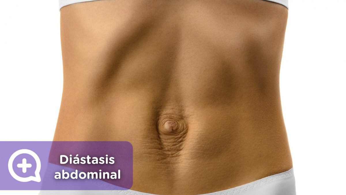 Diástasis abdominal. Embarazo, Vientre, abdominales. Mujer. Mediquo, Tu amigo médico. Chat médico.