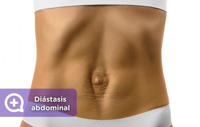 Diástasis abdominal. Embarazo, Vientre, abdominales. Mujer. Mediquo, Tu amigo médico. Chat médico.