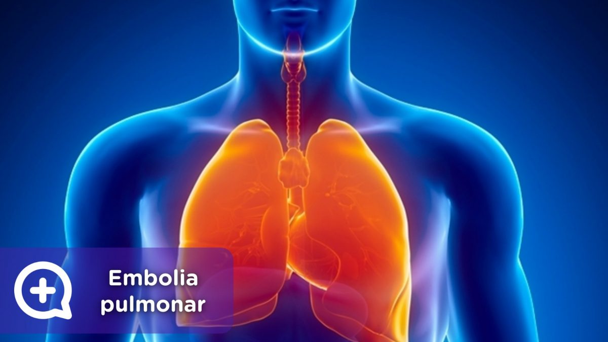 Embolia pulmonar, TVP, coágulo de sangre. Mediquo, Tu amigo médico. Chat médico.