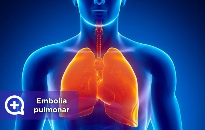 Embolia pulmonar, TVP, coágulo de sangre. Mediquo, Tu amigo médico. Chat médico.