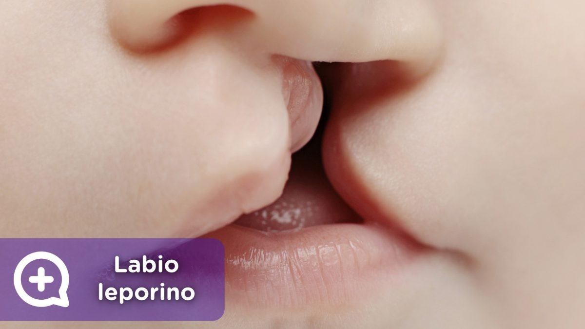 Labio leporino, fisura labial. recién nacidos, labios. mediquo, tu amigo médico. Chat médico.