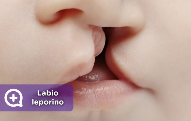 Labio leporino, fisura labial. recién nacidos, labios. mediquo, tu amigo médico. Chat médico.