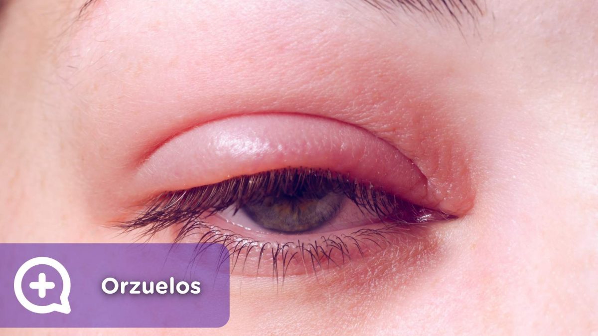 orzuelos, infección ojos, ocular, bacterias, virus. Mediquo, tu amigo médico. Chat médico.