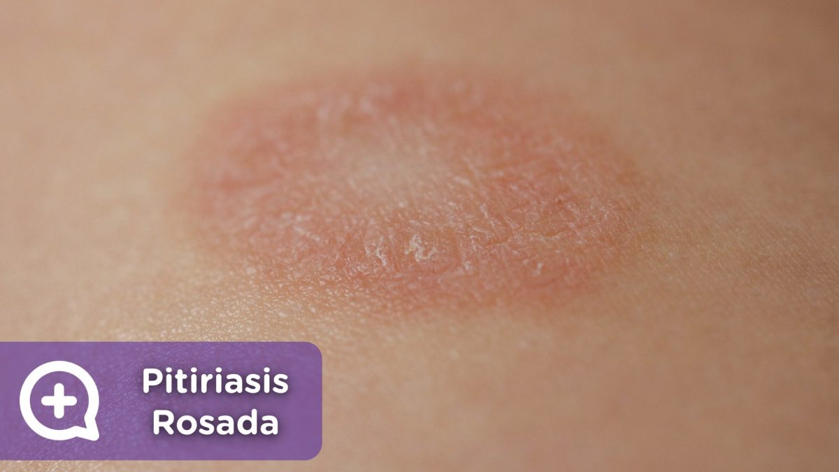 pitiriasis rosada de gibert. erupción, piel, dermatología, mediquo, tu amigo médico. Chat médico.