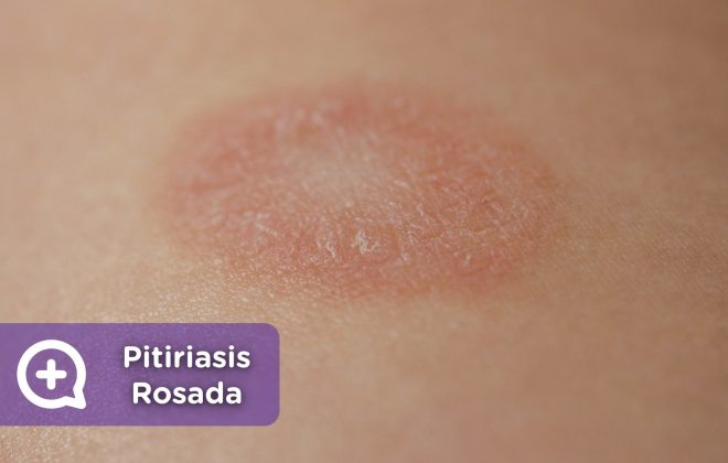 pitiriasis rosada de gibert. erupción, piel, dermatología, mediquo, tu amigo médico. Chat médico.