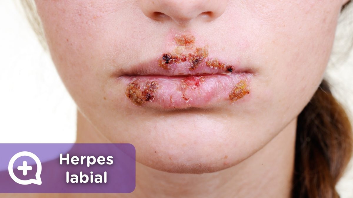 herpes labial, virus, contagio, labio, vhs,. Mediquo, tu amigo médico. Chat médico.