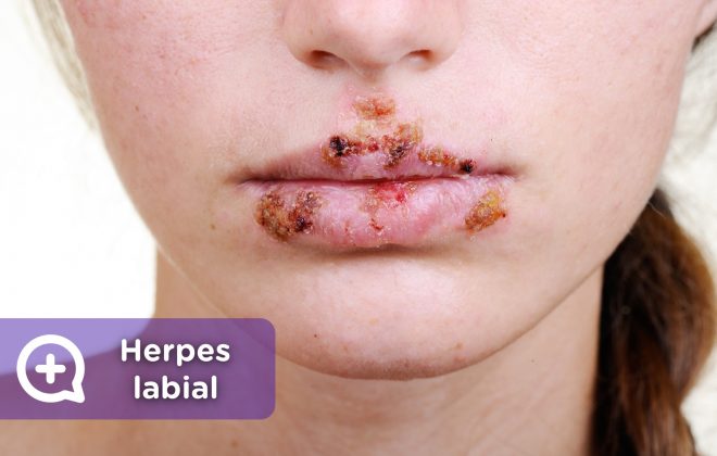 herpes labial, virus, contagio, labio, vhs,. Mediquo, tu amigo médico. Chat médico.